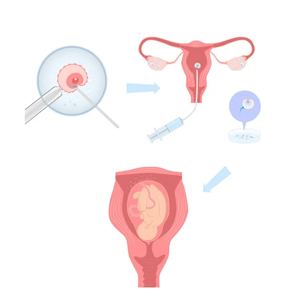 Illustrazione dell'inseminazione artificiale, infografica di processo. Illustrazione vettoriale — Vettoriale Stock