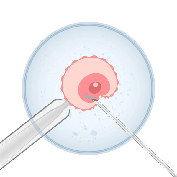 El óvulo y el esperma en la aguja bajo el microscopio. Inseminación artificial, ilustración — Archivo Imágenes Vectoriales