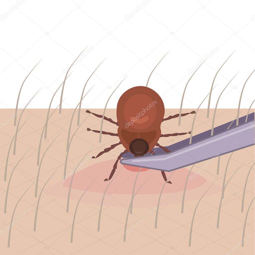 Forest tick bite. The tick grabbed onto the skin, it is removed with tweezers. Vector