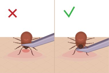 Kene insanı ısırır. Bir kenenin deriden nasıl çıkarılacağını. Hastalık taşıyan bir parazit. Vektör