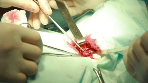 Equipo Cirugía Real Operando Adenoma Garganta Cerca — Vídeo de stock
