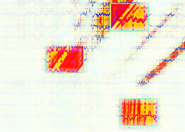 Ondas cerebrales en electroencefalograma eeg para la epilepsia — Stok fotoğraf