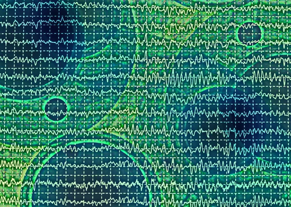 Onda cerebrale su elettroencefalogramma EEG per epilessia — Foto Stock