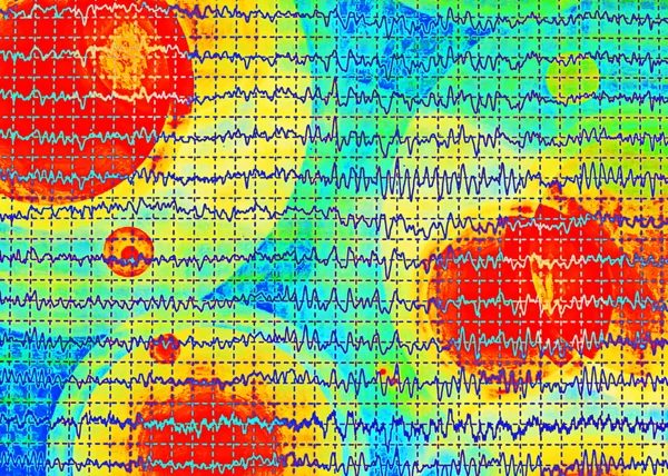 Brain wave on electroencephalogram EEG for epilepsy — Stock Photo, Image