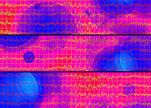 Hjärnan våg på elektroencefalogram EEGEN för epilepsi — Stockfoto