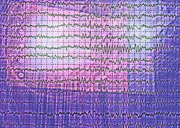 Onde cérébrale sur électroencéphalogramme EEG pour épilepsie — Photo