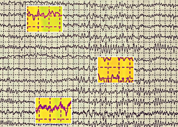 Onda cerebrale su elettroencefalogramma EEG per epilessia — Foto Stock
