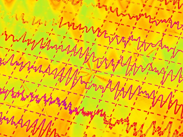 Gehirnwelle auf Elektroenzephalogramm, Epilepsie, Illustration — Stockfoto