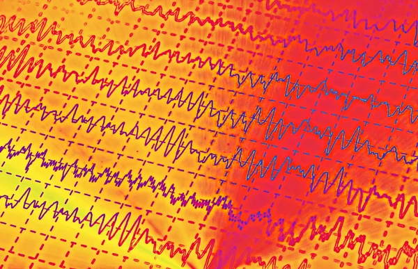 Хвиля мозку на електроенцефалограмі, ЕЕГ для епілепсії, ілюстрація — стокове фото