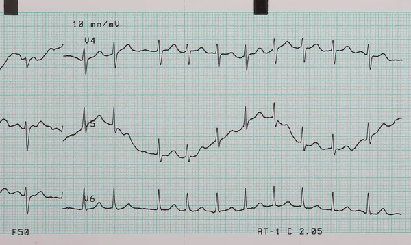 EKG aritmia assoluta, sfondo stampato — Foto Stock