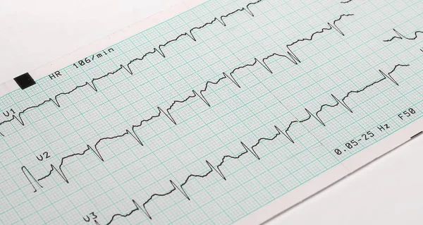 EKG arrhythmia absoluta, printout background — Stock Photo, Image