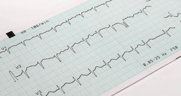 EKG arrhythmia absoluta, printout background