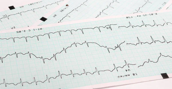 EKG kalp ritim bozukluğu absoluta, Yazdır arka plan — Stok fotoğraf