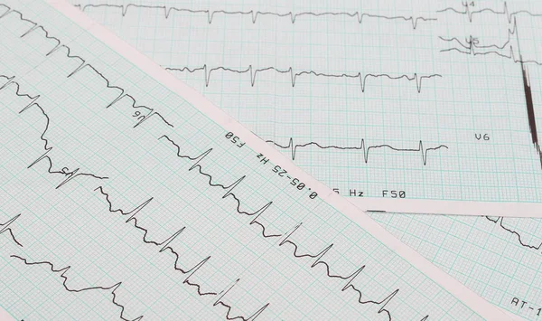 EKG ritmuszavar szerepét, nyomtatás a háttérben — Stock Fotó