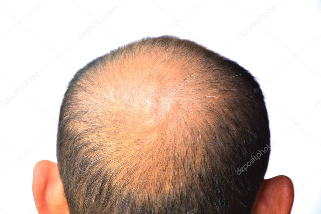 Head of man lose one's hair, glabrous on his head for elderly ma