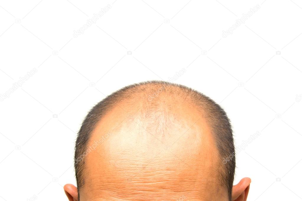 Head of man lose one's hair, glabrous on his head