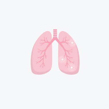 İnsan akciğer hastalık anatomi diyagramı. Akciğer kanseri (astım, tüberküloz, pnömoni). Solunum sistemi