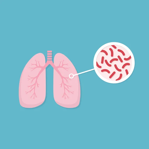 Tüdő a fertőzött személy. Mycobacterium tuberculosis közelről. Tuberkulózis baktériumok veszély — Stock Vector
