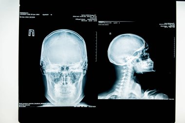 insan x-ışını fotoğrafı