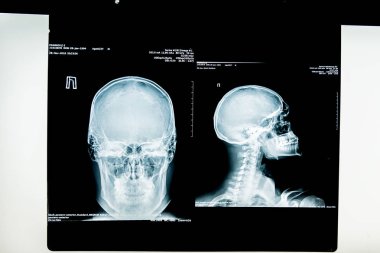 insan x-ışını fotoğrafı