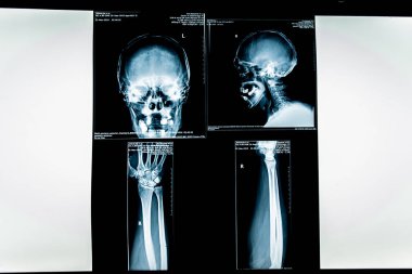 insan x-ışını fotoğrafı
