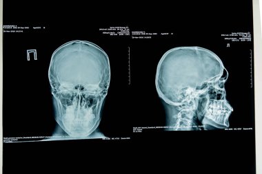 insan x-ışını fotoğrafı