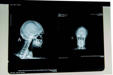 insan x-ışını fotoğrafı