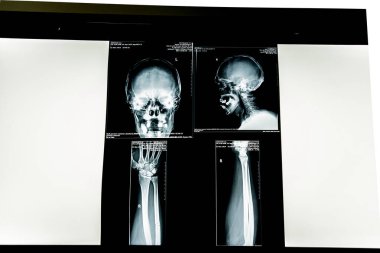 insan x-ışını fotoğrafı