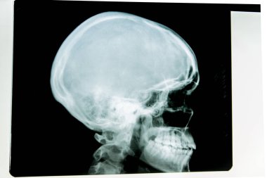 insan x-ışını fotoğrafı