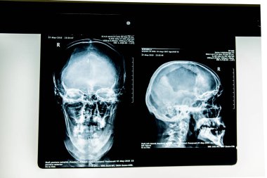 insan x-ışını fotoğrafı