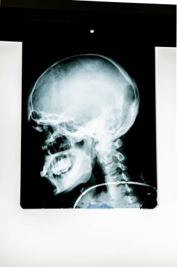 insan x-ışını fotoğrafı