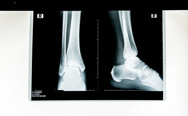 Рентгенівський знімок людини — стокове фото