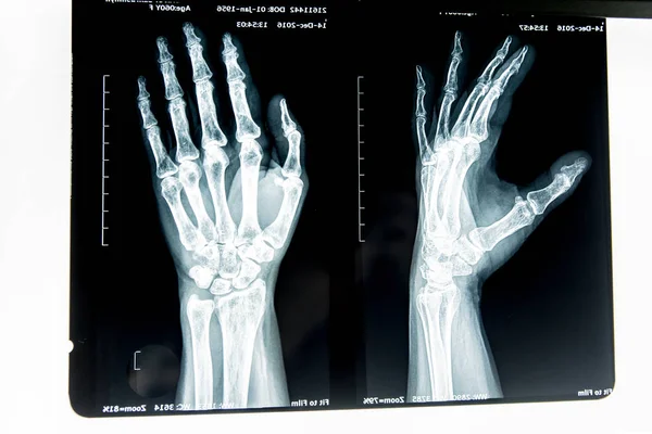 Рентгеновский снимок человека — стоковое фото