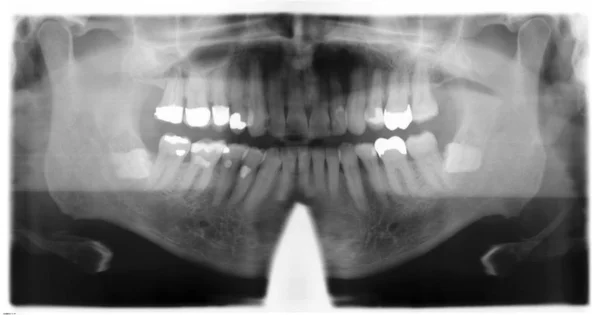 Roentgenografia dentária imagem — Fotografia de Stock