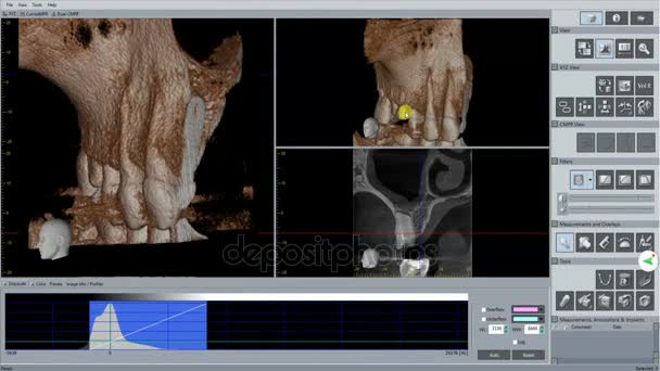 Lekarz sprawdza stomatologiczne skanowania 3d dla przyszłych implantu — Wideo stockowe