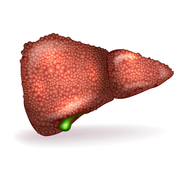 肝硬変肝臓の解剖学のイラストの — ストックベクタ