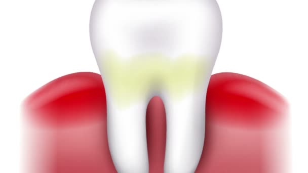 Formation de caries dentaires, plaque dentaire, perte de calcium, phosphate et finalement caries et cavité — Video