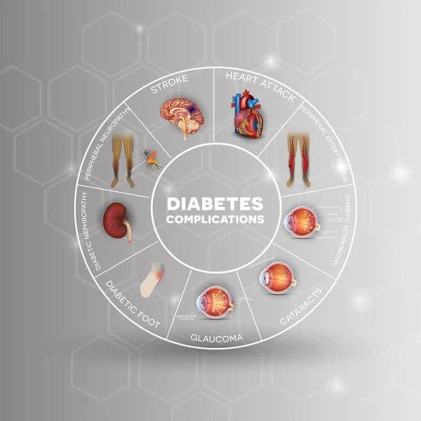 Diabète sucré organes touchés — Image vectorielle