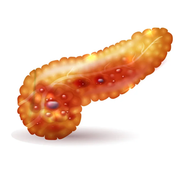 Pancreatitis illustration, inflammation of pancreas on a white b — Stock Vector