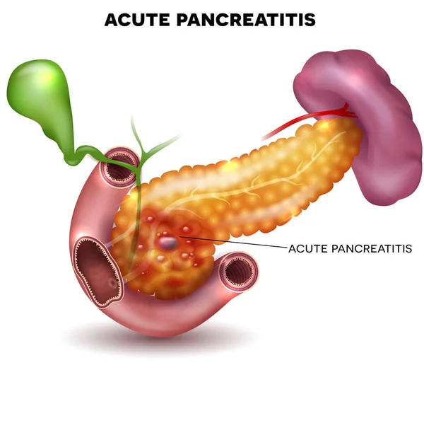 Akut pankreatit illustration — Stock vektor