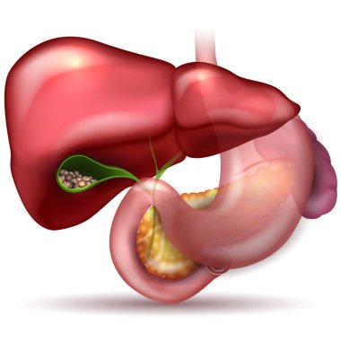 Gallstones in the Gallbladder and anatomy of surrounding organs. clipart