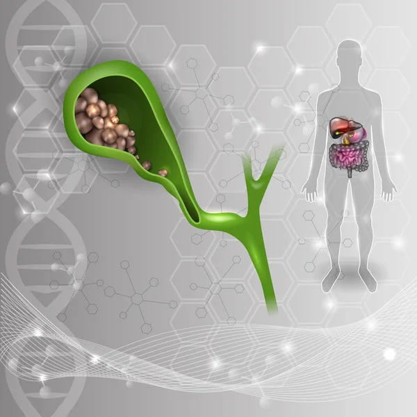 Камни в желчном пузыре, анатомия яркий подробный иллюстрат — стоковый вектор