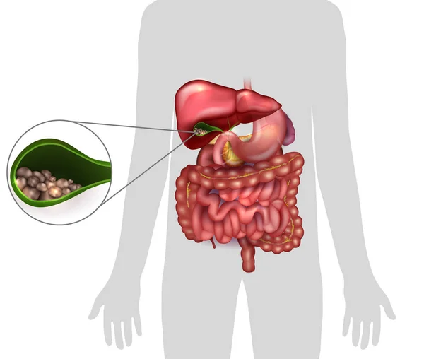 Gallstones in the Gallbladder, human silhouette and anatomy of s — Stock Vector
