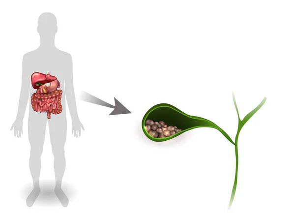 Gallstones in the Gallbladder, anatomy bright detailed illustrat — Stock Vector