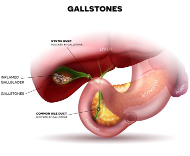 Gallstones in the Gallbladder clipart