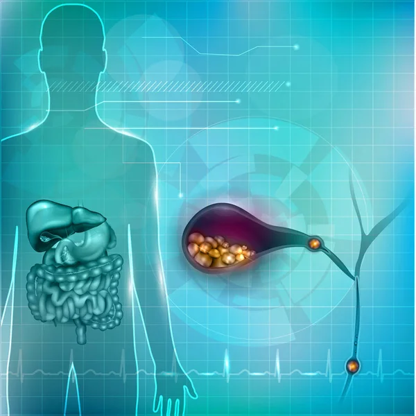 Žlučové kameny v žlučníku — Stockový vektor