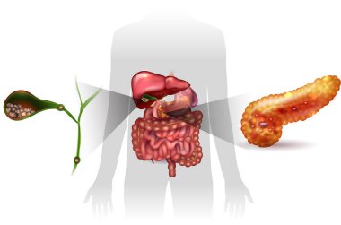 Gallstones and pancreatitis clipart