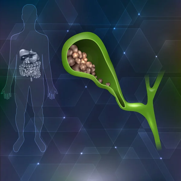 Pedras biliares e silhueta humana com órgãos internos resumo ele —  Vetores de Stock