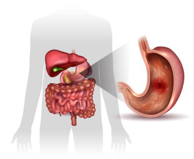 Stomach ulcer, interanal organs anatomy colorful drawing clipart