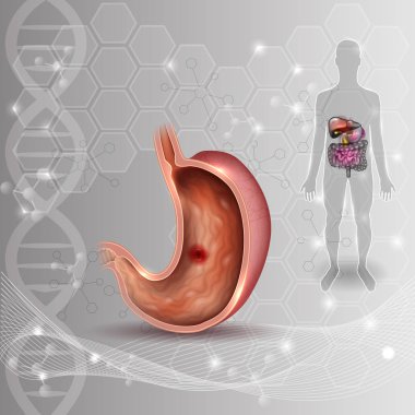Mide ülseri, iç organların anatomisi renkli çizim 